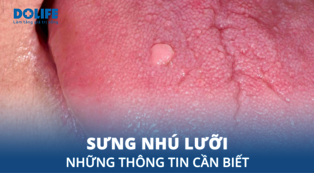 Sưng nhú lưỡi: Những thông tin cần biết