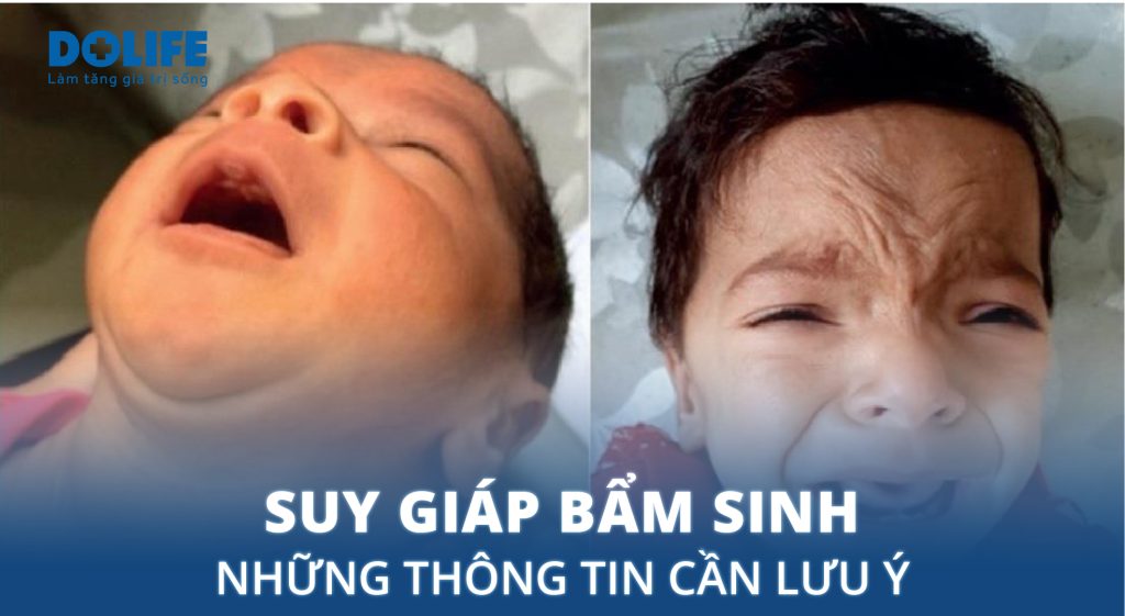 Suy giáp bẩm sinh: Triệu chứng, chẩn đoán và điều trị