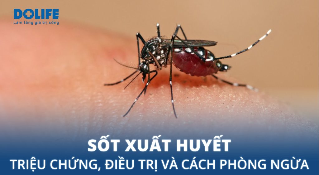 Sốt xuất huyết: Triệu chứng, điều trị và cách phòng ngừa