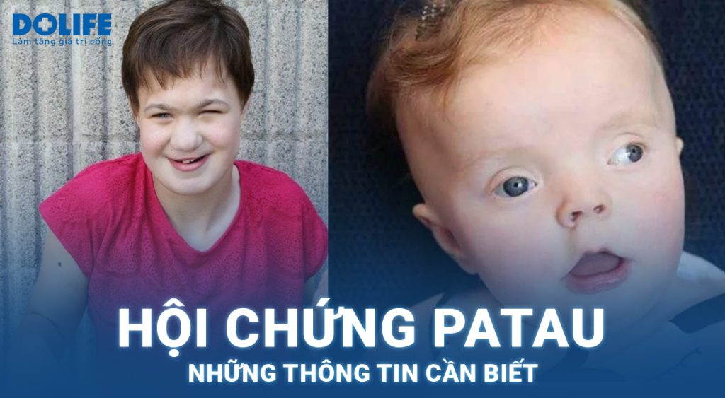 Hội chứng Patau: Những thông tin cần biết