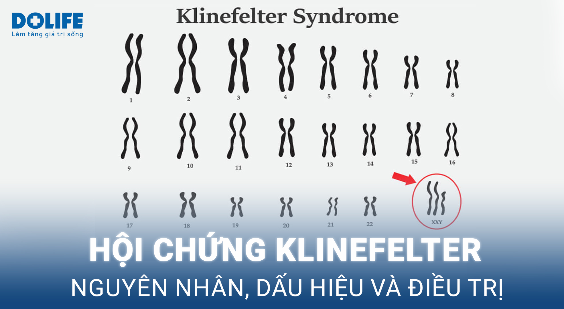 Hội chứng Klinefelter gây thiểu năng sinh dục và vô sinh ở nam giới