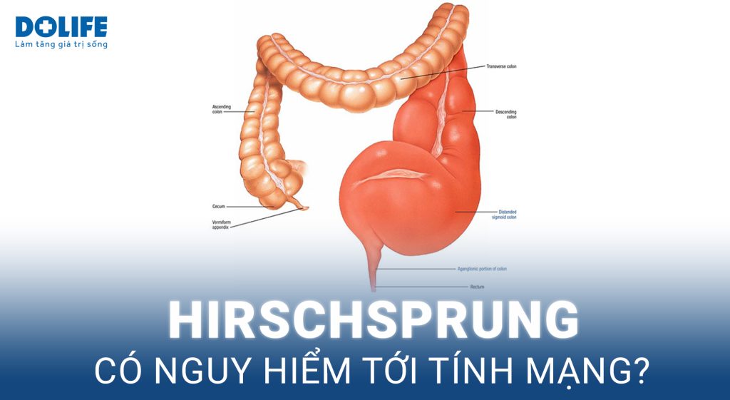 Hirschsprung (phình đại tràng bẩm sinh: Nguyên nhân, triệu chứng và cách điều trị