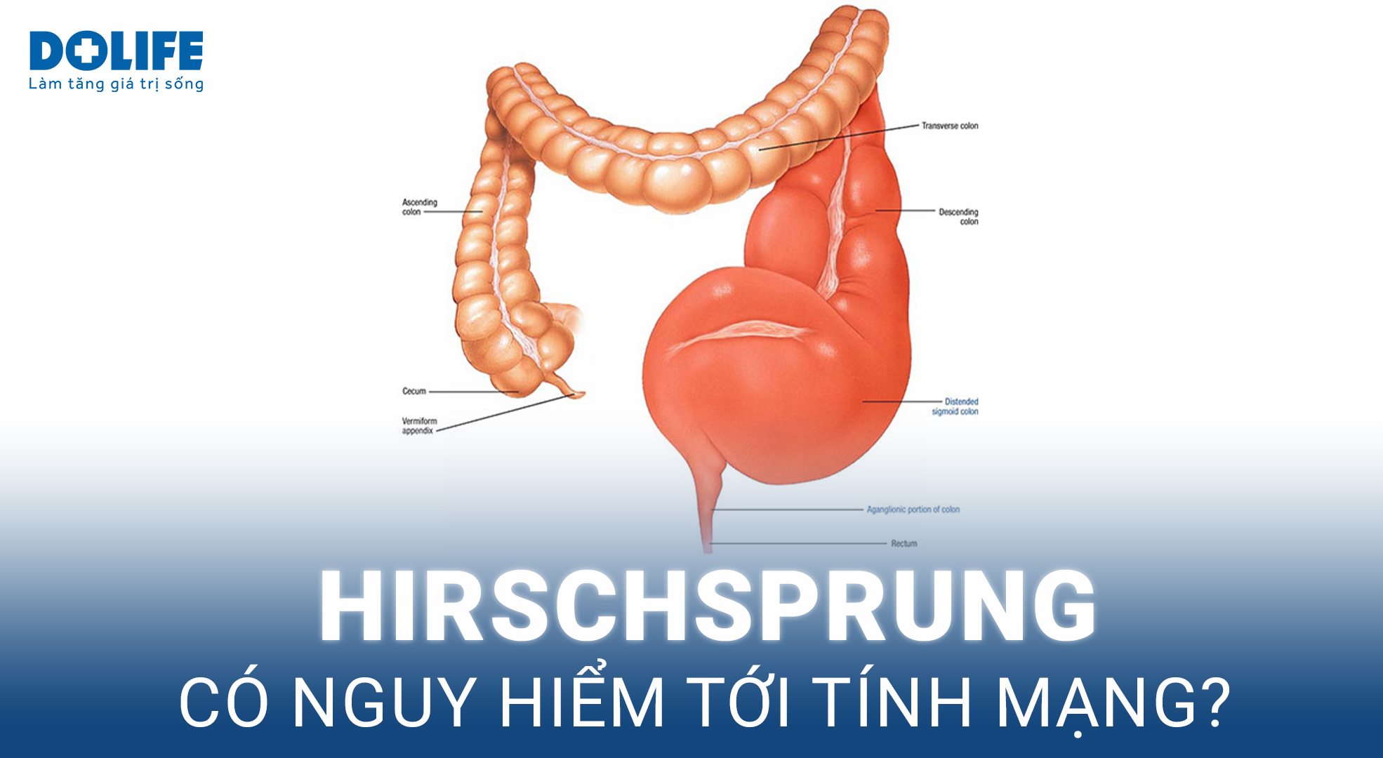 Hirschsprung: Phình đại tràng bẩm sinh