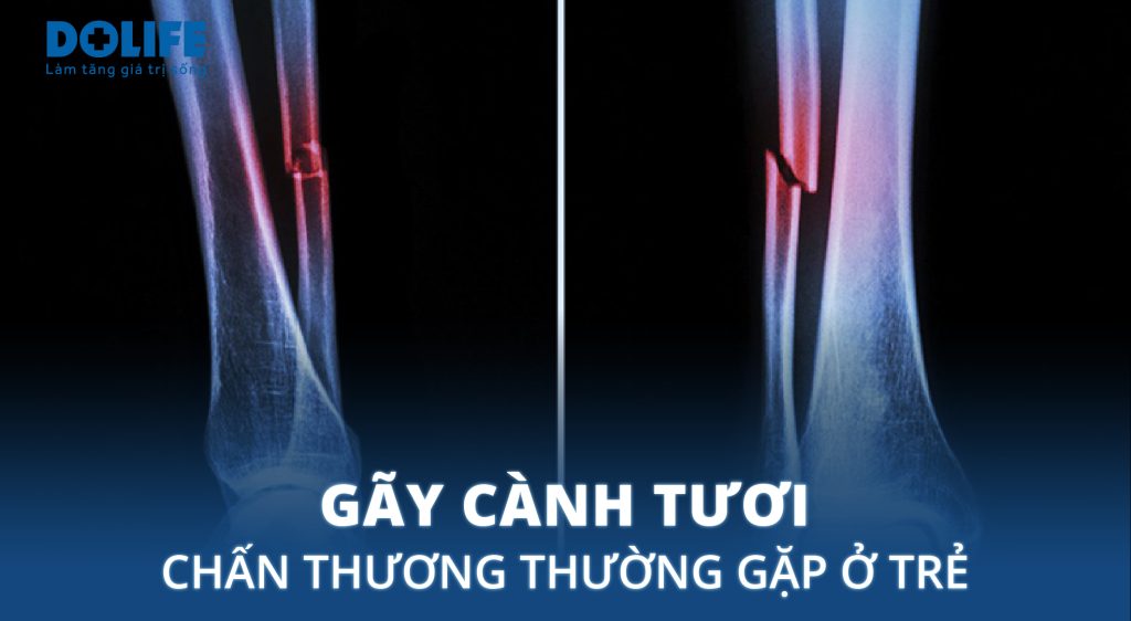 Gãy cành tươi: Dấu hiệu nhận biết và điều trị