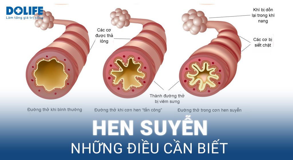 Hen suyễn: Dấu hiệu nhận biết và điều trị