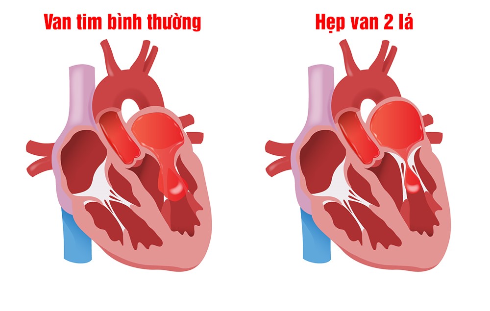 Hẹp van hai lá có thể gây ra nhiều biến chứng tim mạch nguy hiểm