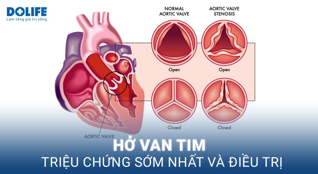 Hở van tim: Bệnh lý tim mạch gây nhiều biến chứng nguy hiểm 