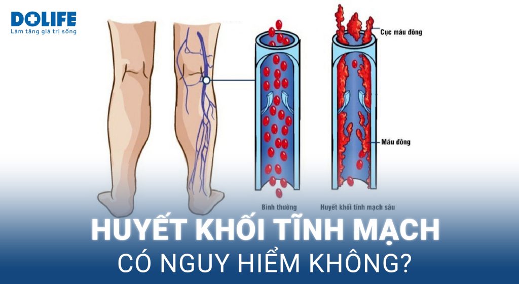 Huyết khối tĩnh mạch: Dấu hiệu nhận biết, biến chứng và điều trị