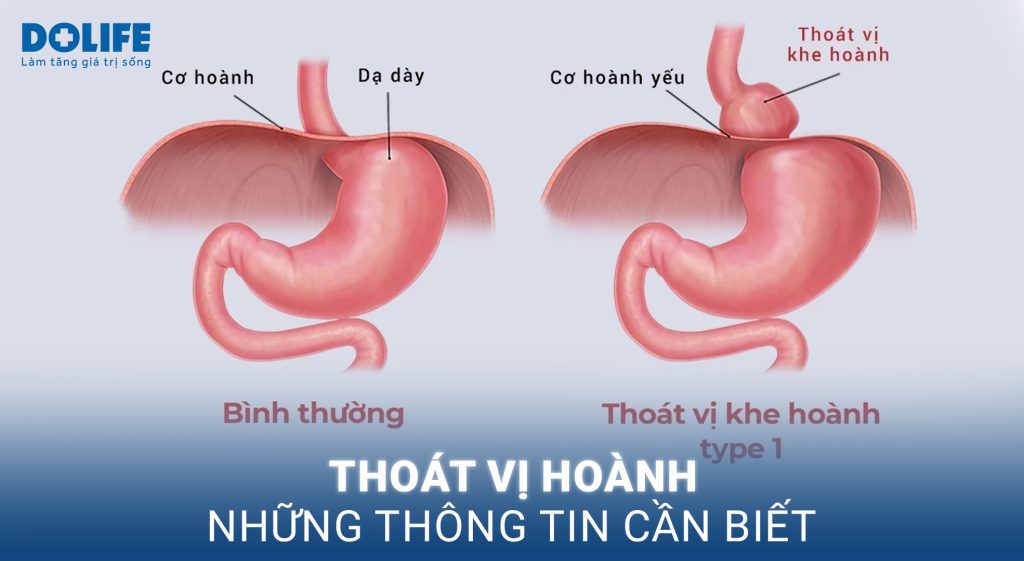 Thoát vị hoành: Những thông tin cần biết