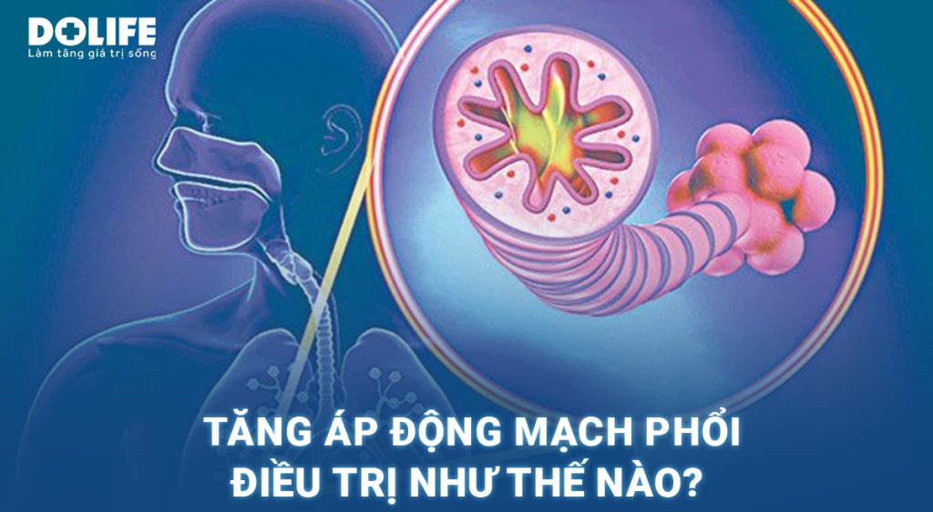 Tăng áp động mạch phổi: Triệu chứng và cách điều trị