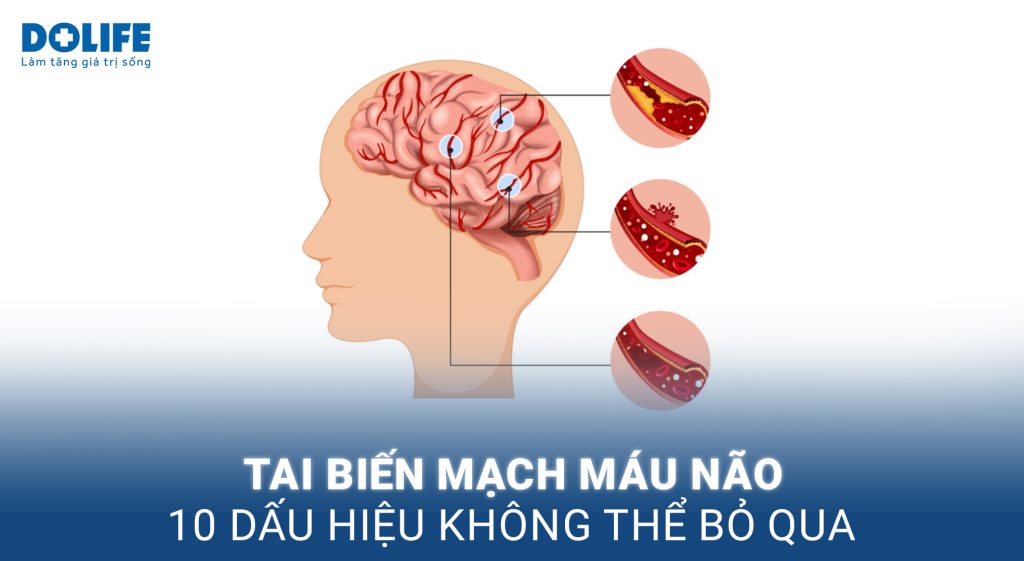 10 Dấu hiệu tai biến mạch máu não nguy hiểm không thể bỏ qua