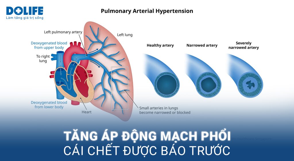 Tăng áp động mạch phổi: Dấu hiệu nhận biết và điều trị