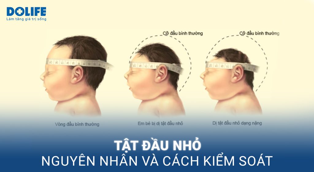 Tật đầu nhỏ: Những dấu hiệu không thể bỏ qua