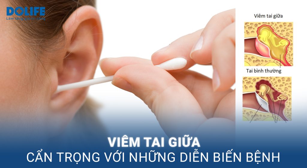 Viêm tai giữa: Nguyên nhân, dấu hiệu nhận biết và điều trị