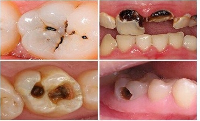 Sâu răng: Triệu chứng và cách điều trị