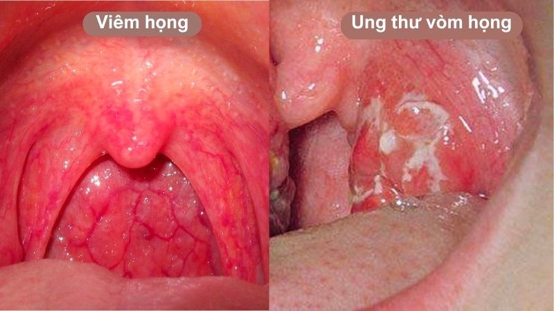 Triệu Chứng Nhận Biết Ung Thư Vòm Họng