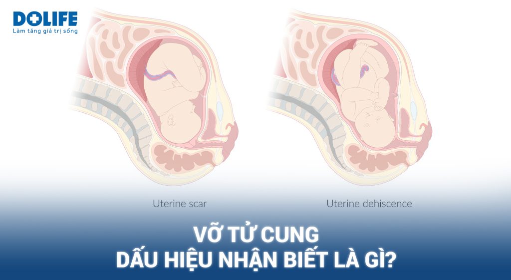 Vỡ tử cung: Dấu hiệu nhận biết và cách phòng ngừa