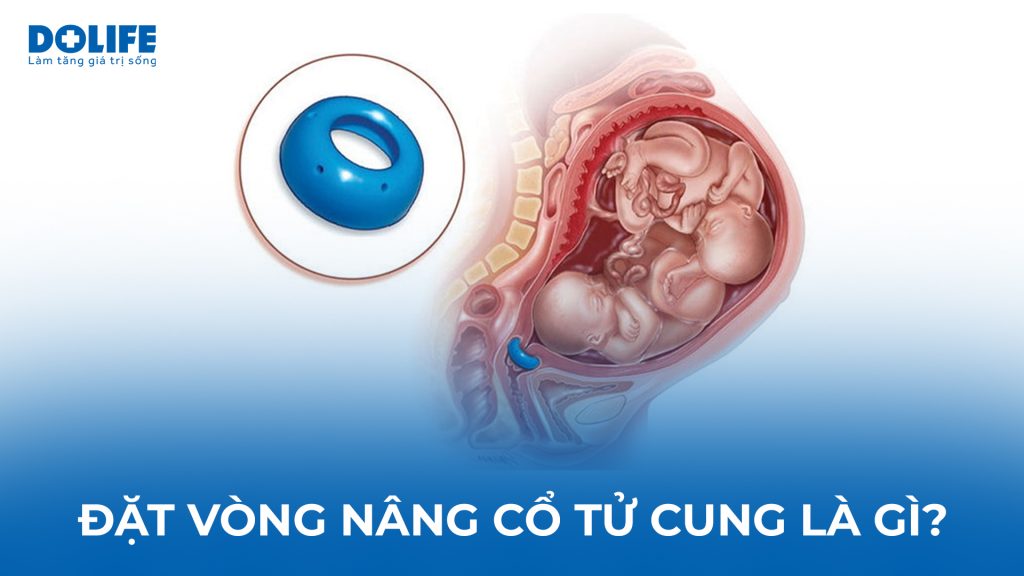 Đặt vòng nâng cổ tử cung: Những thông tin cần biết