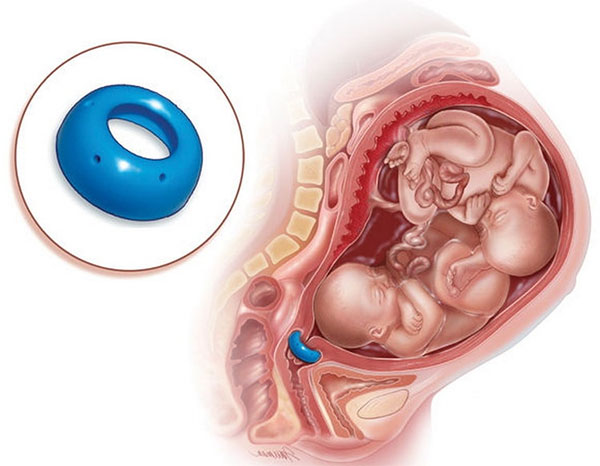 Đặt vòng nâng cổ tử cung: Những thông tin cần biết