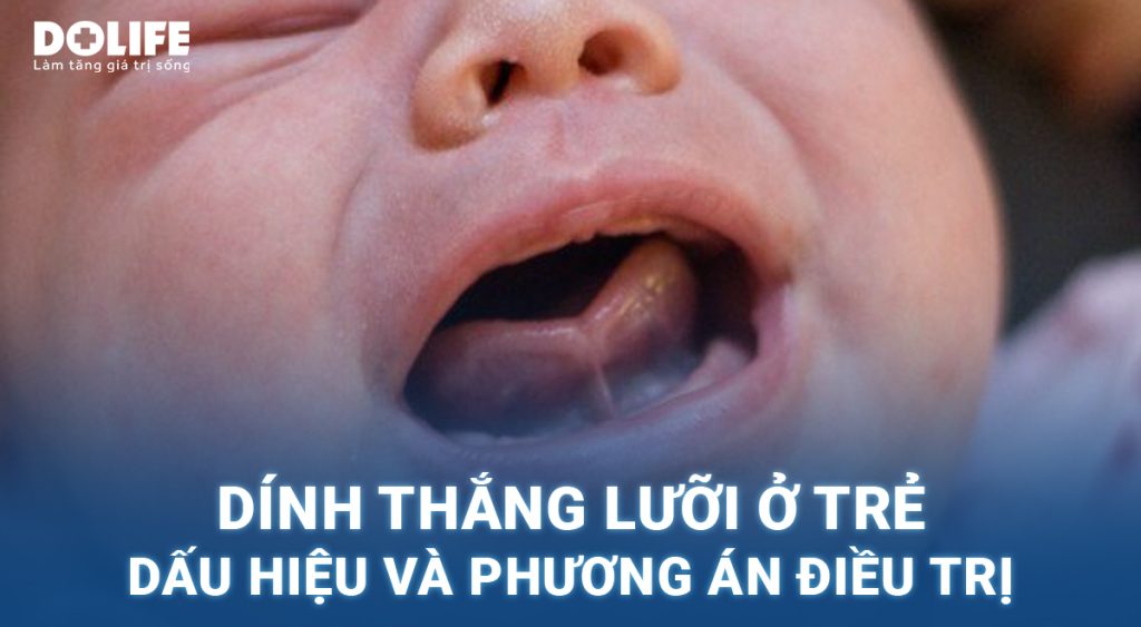 Dính thắng lưỡi ở trẻ: Dấu hiệu và phương án điều trị