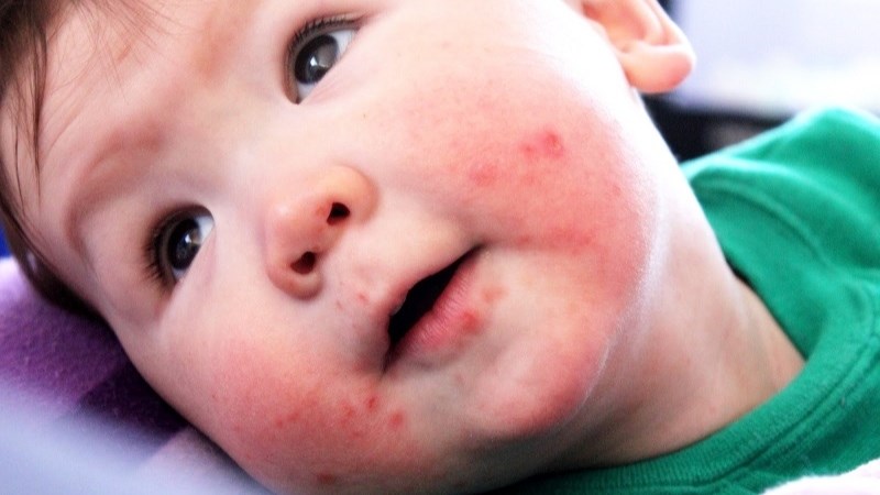 Bệnh kawasaki ở trẻ có nguy hiểm không? Phương án điều trị là gì?