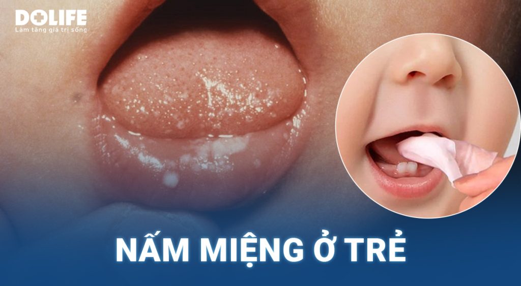 Những điều cha mẹ cần biết về nấm miệng ở trẻ