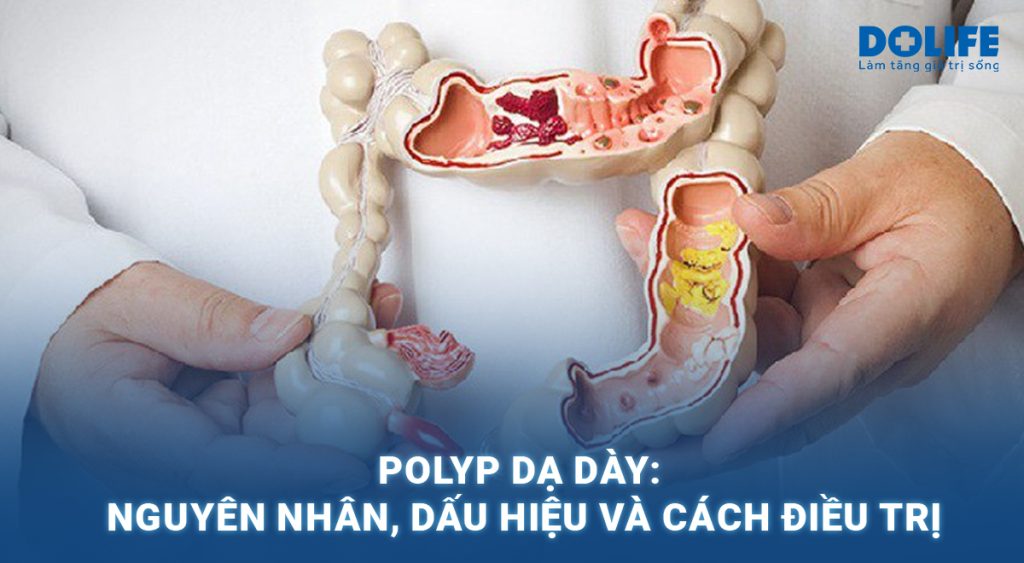 Polyp dạ dày: Dấu hiệu và cách điều trị