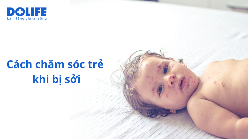 Cách chăm sóc trẻ khi bị sởi