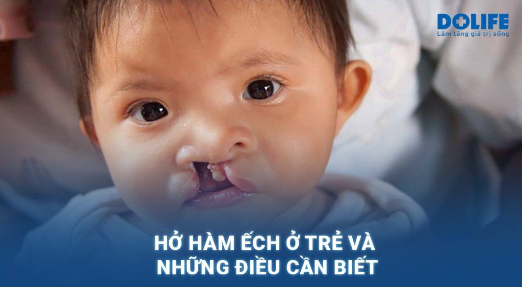 Hở hàm ếch ở trẻ: Nguyên nhân và cách điều trị