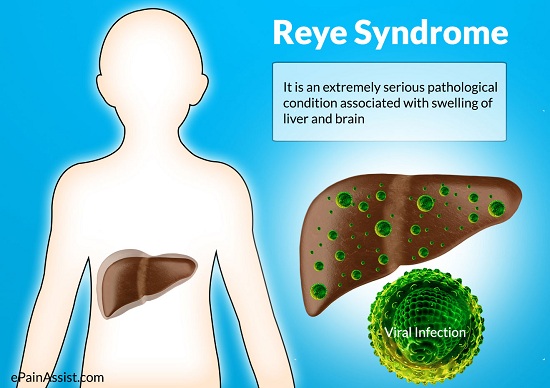 Hội chứng Reye: Nguyên nhân, triệu chứng và cách phòng ngừa