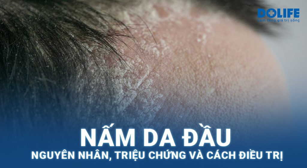 Nấm da đầu có nguy hiểm không? Điều trị thế nào?