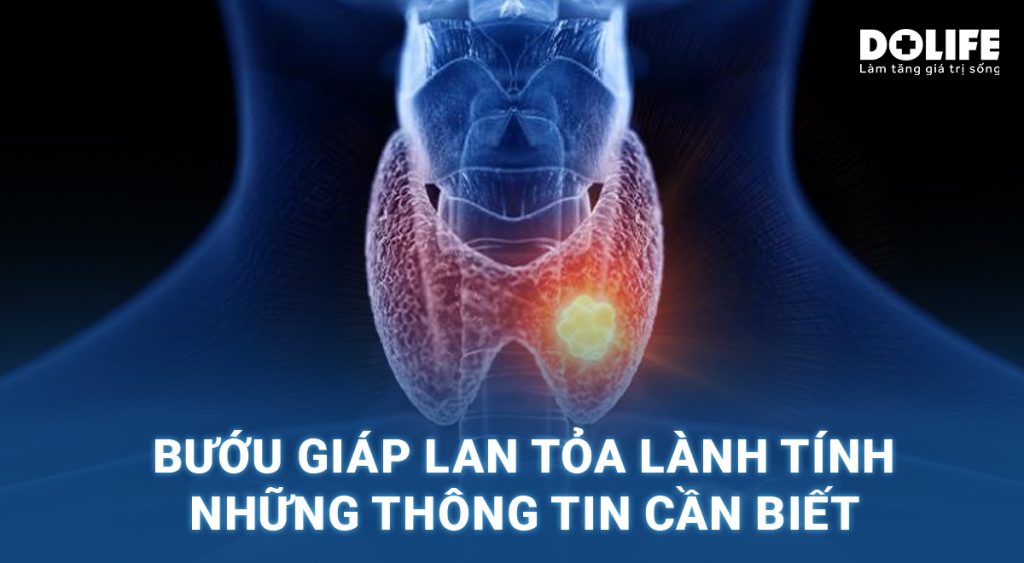 Bướu giáp lan tỏa lành tính có nguy hiểm không?