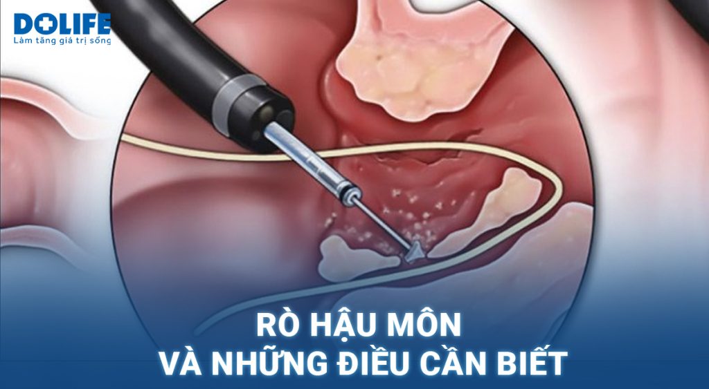 Rò hậu môn: Nguyên nhân, triệu chứng và điều trị