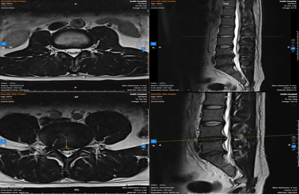 Đau thắt lưng lan xuống chân sau khi cúi người bê đồ, người đàn ông 33 tuổi phát hiện hội chứng thắt lưng hông