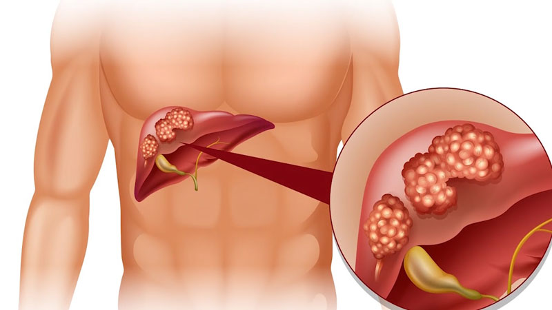 Đau tức hạ sườn phải kéo dài, người đàn ông 42 tuổi phát hiện xơ gan tiến triển