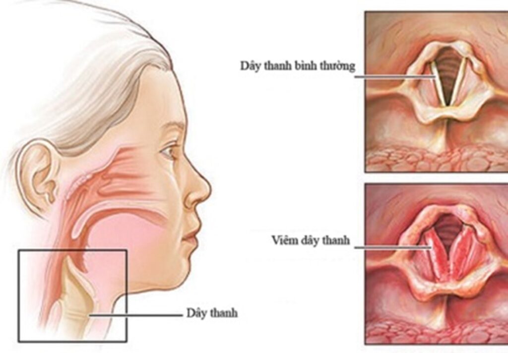 Khàn tiếng kéo dài, rát họng, nuốt vướng: phát hiện trào ngược họng thanh quản kèm hạt xơ dây thanh tại Bệnh viện Quốc tế Dolife