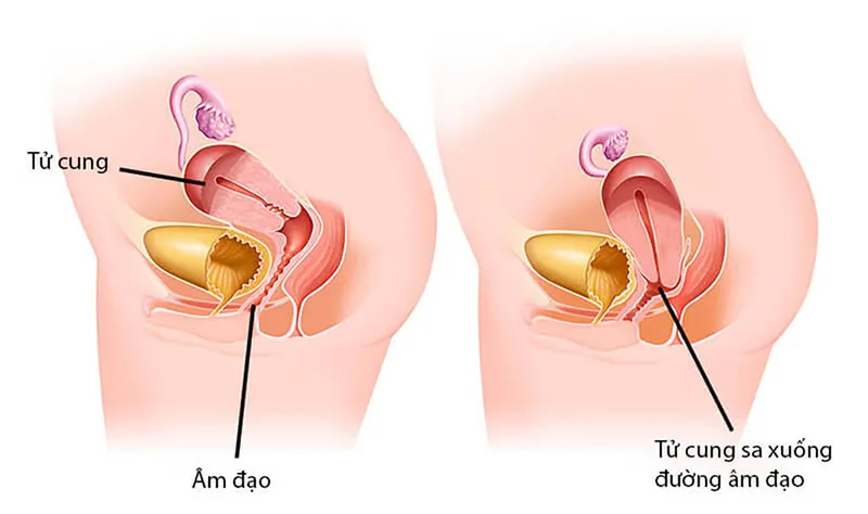 Khám sức khỏe tổng quát phát hiện sa tử cung giai đoạn sớm ở phụ nữ 40 tuổi