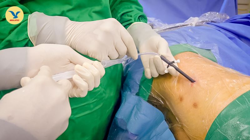 Chi phí tán sỏi thận có đắt không? Bảo hiểm y tế có hỗ trợ chi trả không?